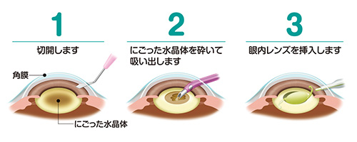 白内障日帰り手術