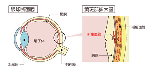 加齢黄斑変性症