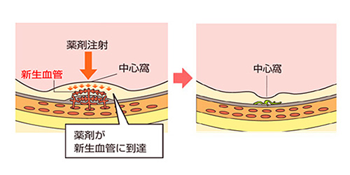 加齢黄斑変性症