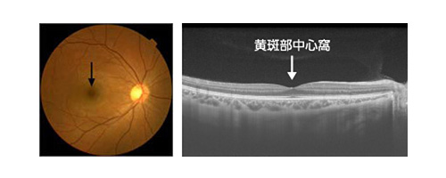 加齢黄斑変性症