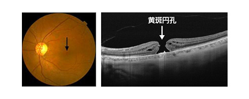 加齢黄斑変性症
