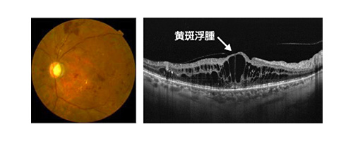 加齢黄斑変性症
