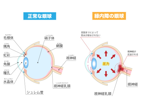 緑内障